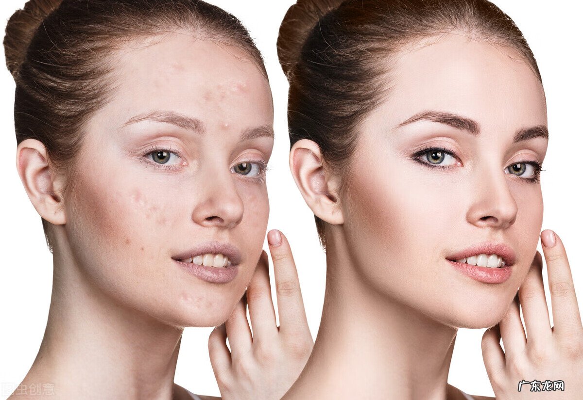 青春痘如何彻底治疗 怎样有效治疗青春痘