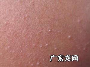 眼睛上长了脂肪粒怎么办 眼睛周围长脂肪粒怎么办?