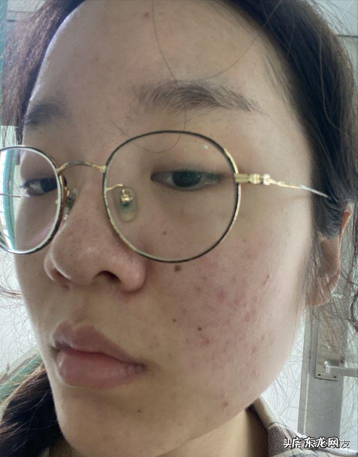 果酸换肤的作用是什么?