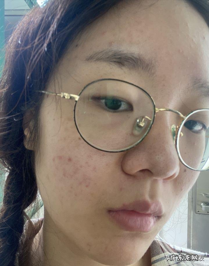 果酸换肤的作用是什么?