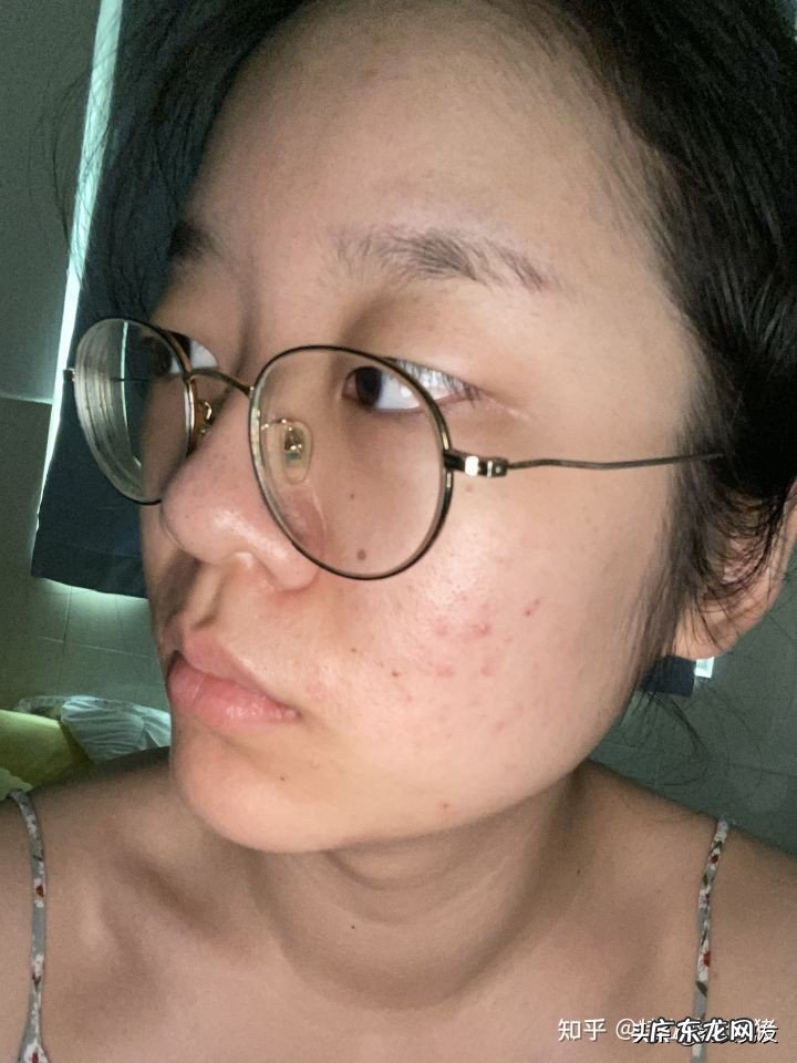 果酸换肤的作用是什么?