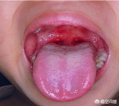 手足口病有什么症状？