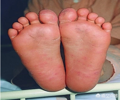 手足口病有什么症状？