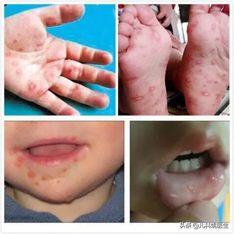 如何预防儿童“手足口病”?