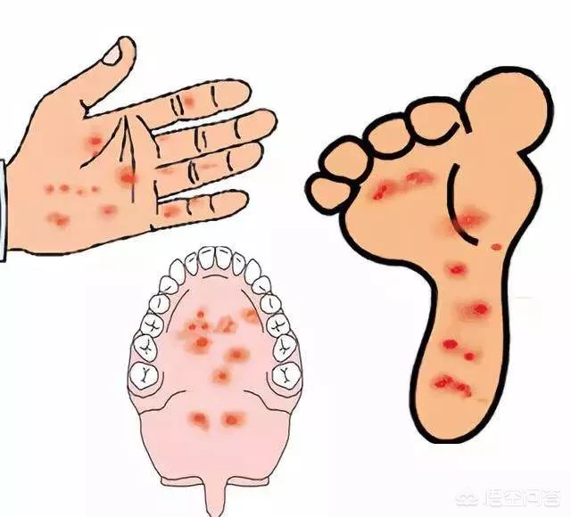 如何预防儿童“手足口病”？