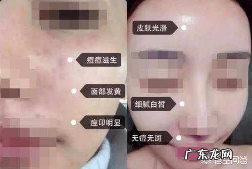 水光针的效果怎么样?你怎么看?