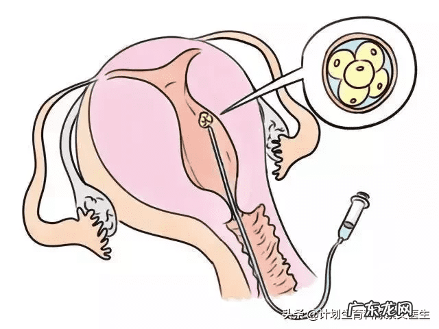 宫外孕后能自然怀孕吗 宫外孕后还可以怀孕吗