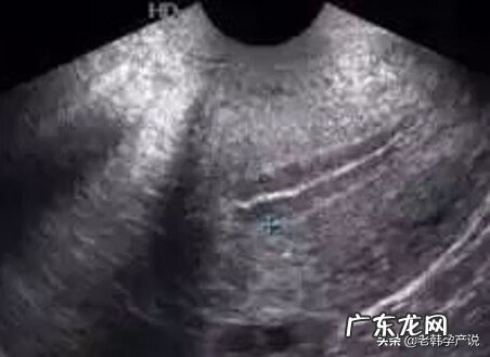 子宫内膜薄吃什么补得最快 子宫内膜薄吃什么食物好