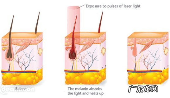 激光脱毛的危害与效果 激光脱毛的危害性
