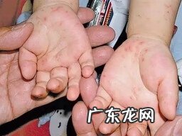 手足口病症状初期图片 手足口病症状有哪些