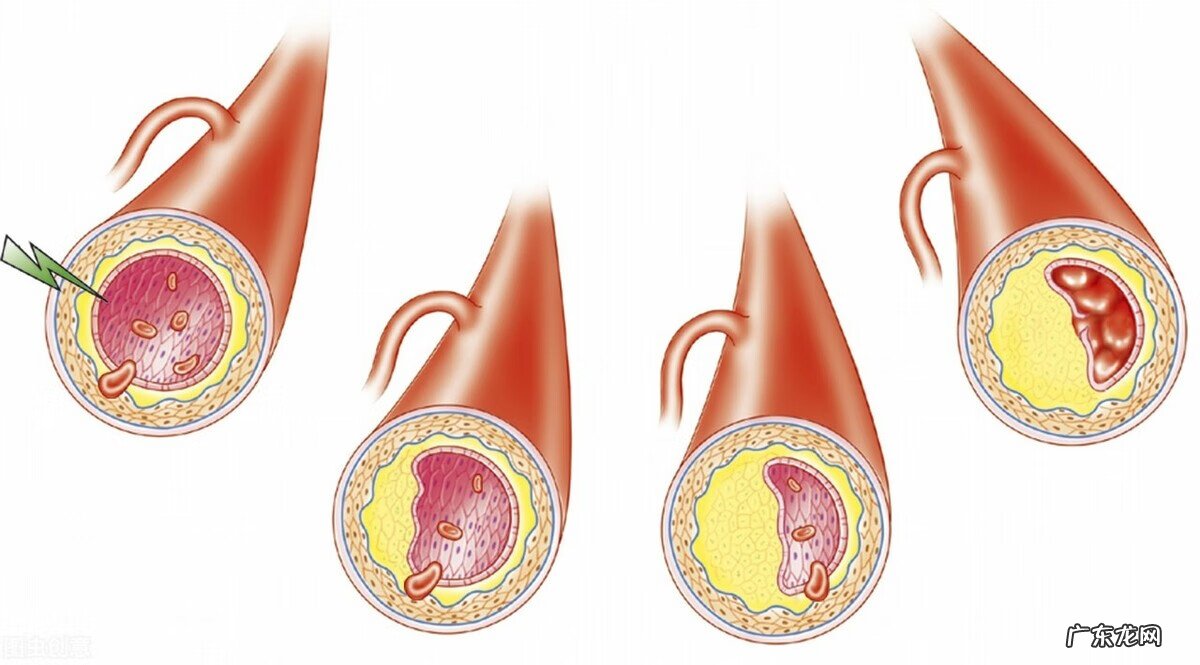 血脂高的人吃什么食物好 血脂高吃什么食物最好