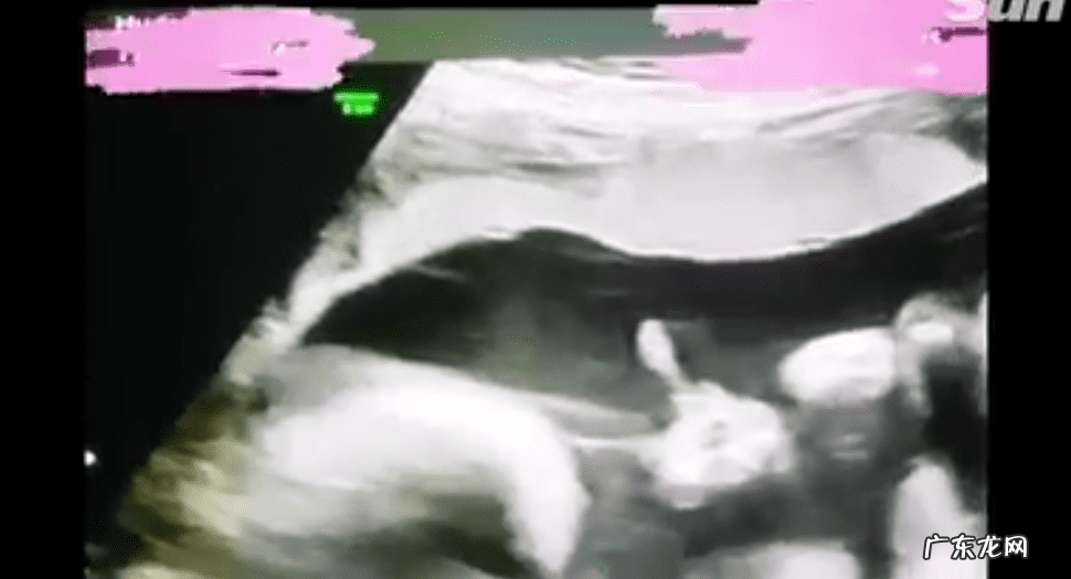 捏中指根部测怀孕的图片 掐中指测怀孕图解