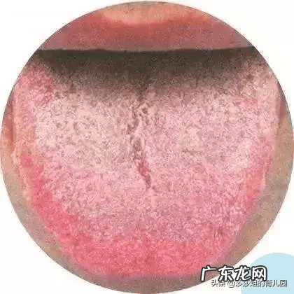 舌头表面发黄是怎么回事 舌头发黄开裂是怎么回事
