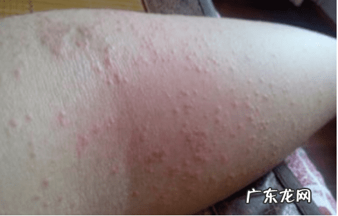 孕妇起了湿疹怎么办啊 孕妇得了湿疹该怎么办