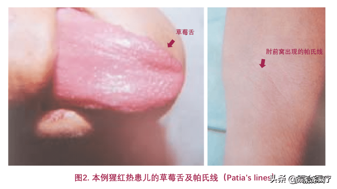 艾滋病发病期舌头症状 艾滋病的初期症状舌头