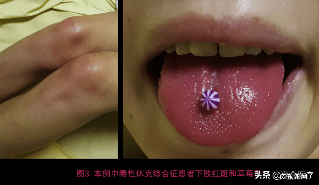 艾滋病发病期舌头症状 艾滋病的初期症状舌头