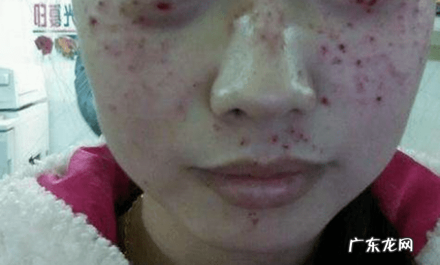 激光去雀斑 用激光祛斑好不好