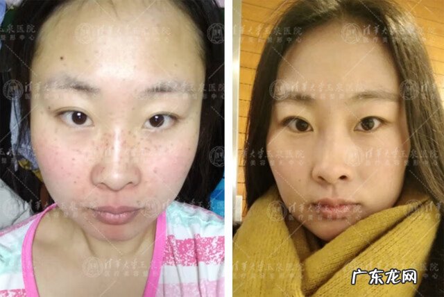 激光去雀斑 用激光祛斑好不好