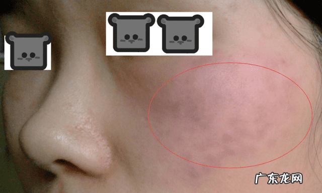 激光去雀斑 用激光祛斑好不好