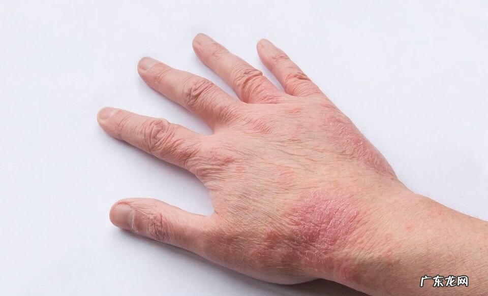 100种皮肤病对照图片大全 湿疹注意事项