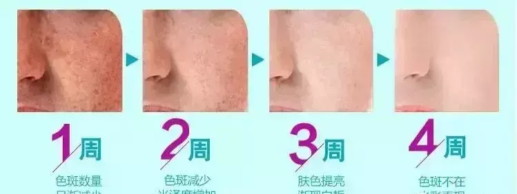 黄褐斑的特点及形成原因 黄褐斑的原因是怎么引起的