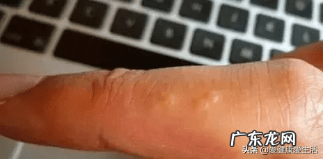 手背上起小水泡很痒 手上起小水泡很痒怎么回事
