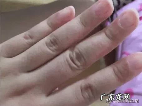 手背上起小水泡很痒 手上起小水泡很痒怎么回事