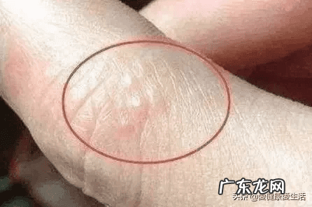手背上起小水泡很痒 手上起小水泡很痒怎么回事
