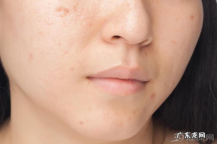 如何有效去除痘印 痘印怎么去除最有效的方法