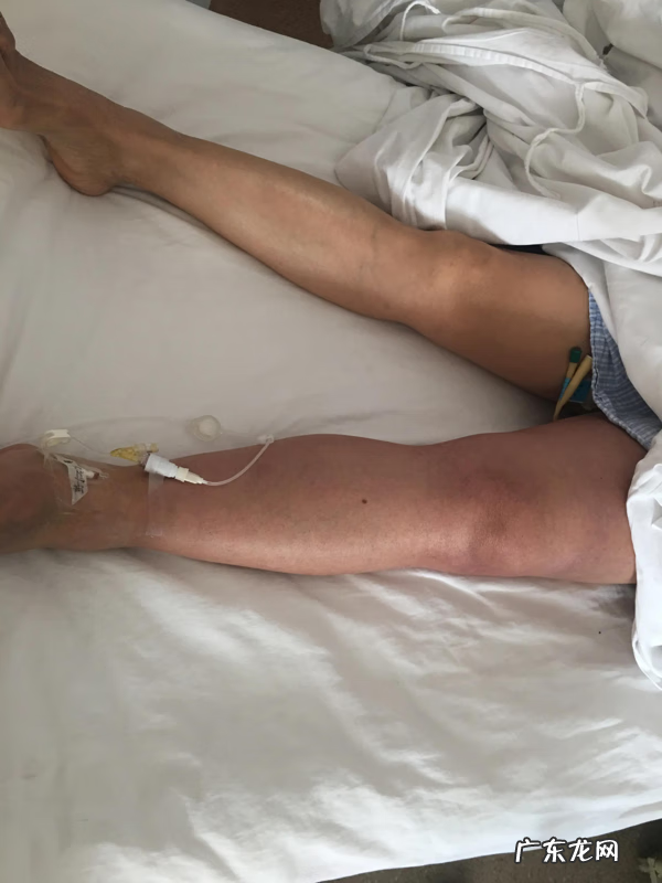 小腿肿是什么原因 腿肿是什么原因造成的