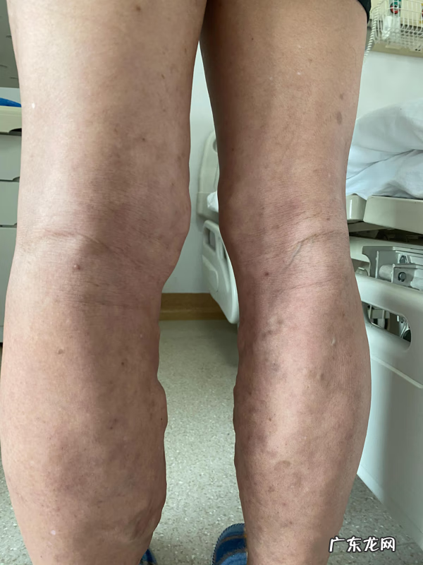 小腿肿是什么原因 腿肿是什么原因造成的