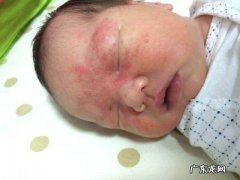 新生儿皮肤红疹 新生儿红疹怎么办