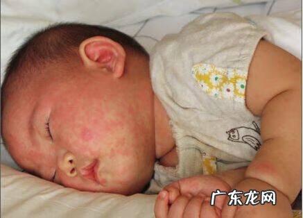 新生儿皮肤红疹 新生儿红疹怎么办