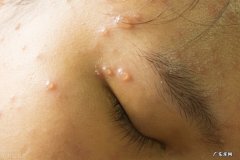 刚长的水痘是什么样子图片 水痘的症状和治疗方法