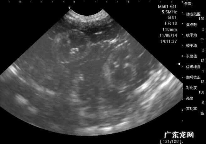 b超单看男女的方法 b超看男女多少钱