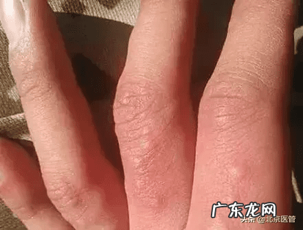 脚上长小水泡很痒怎么治 脚上起小水泡很痒是怎么回事图片