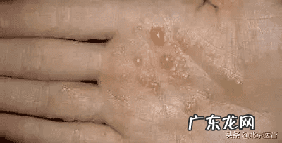 脚上长小水泡很痒怎么治 脚上起小水泡很痒是怎么回事图片