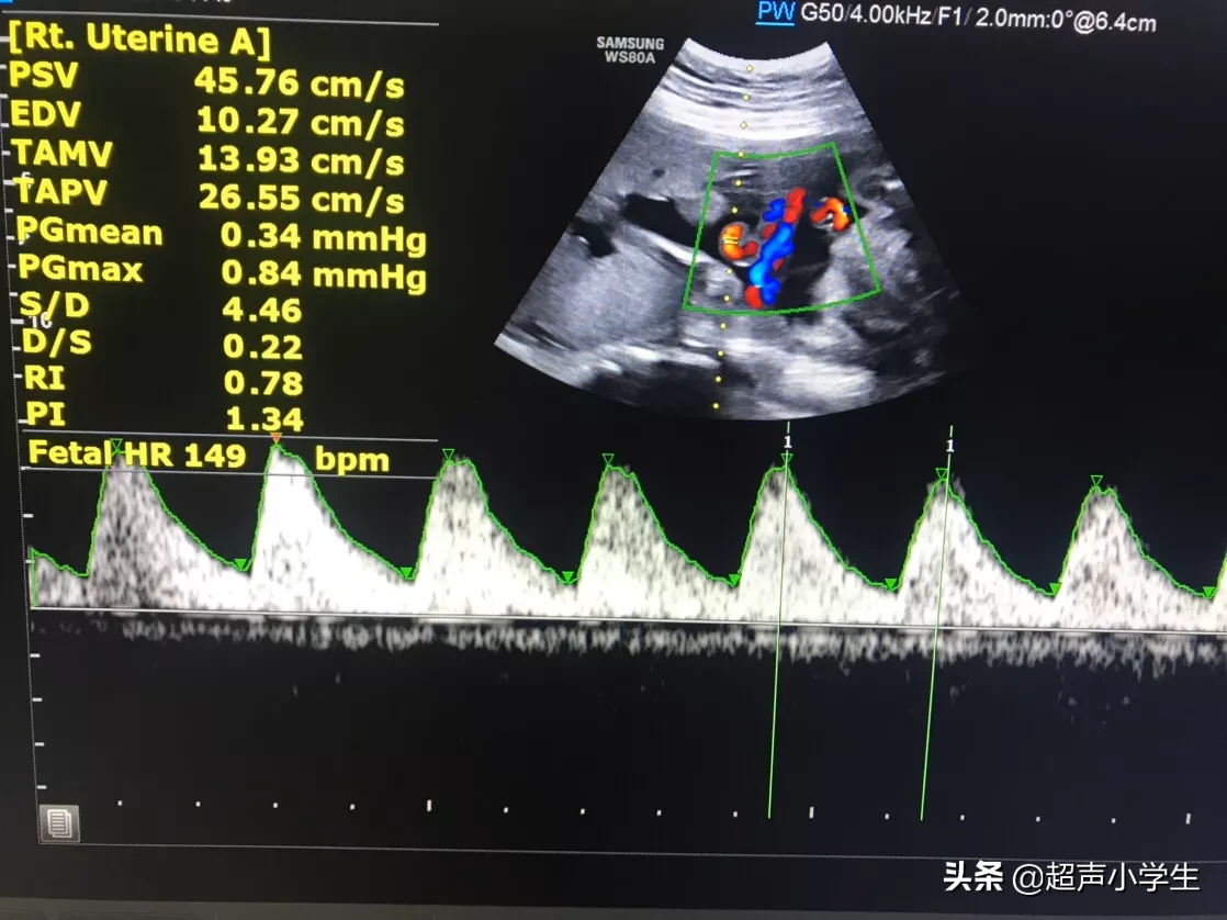 怀孕生男孩,胎心率是每分钟多少下?怀孕时应注意什么?