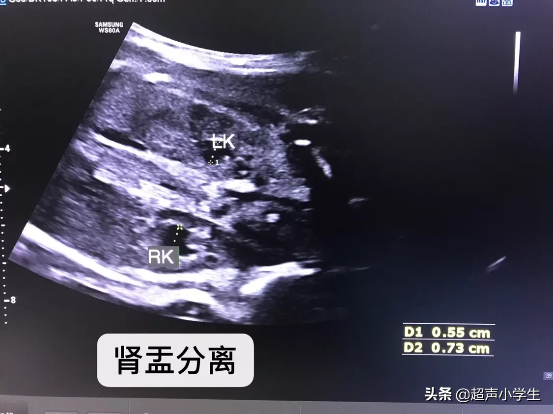 怀孕生男孩,胎心率是每分钟多少下?怀孕时应注意什么?