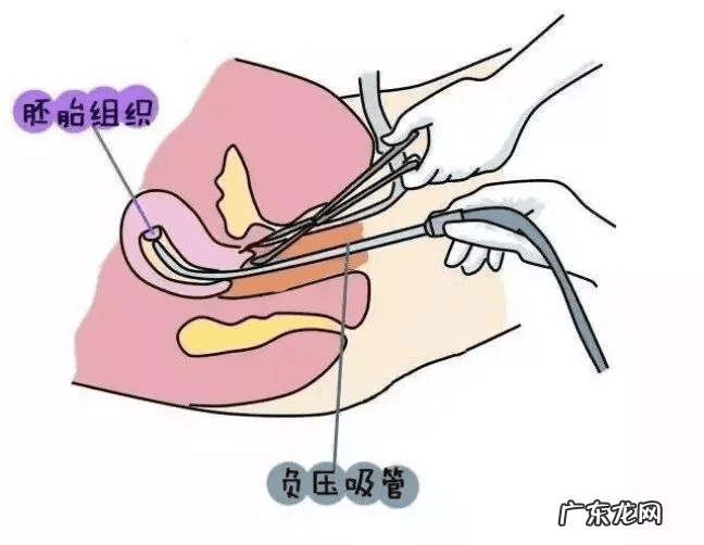 做人流痛苦吗我害怕 2个月做人流痛吗