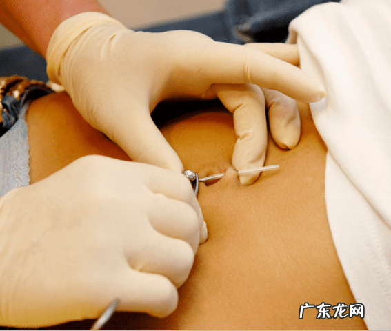 脖子湿疹拔罐 湿疹拔罐放血治疗湿疹