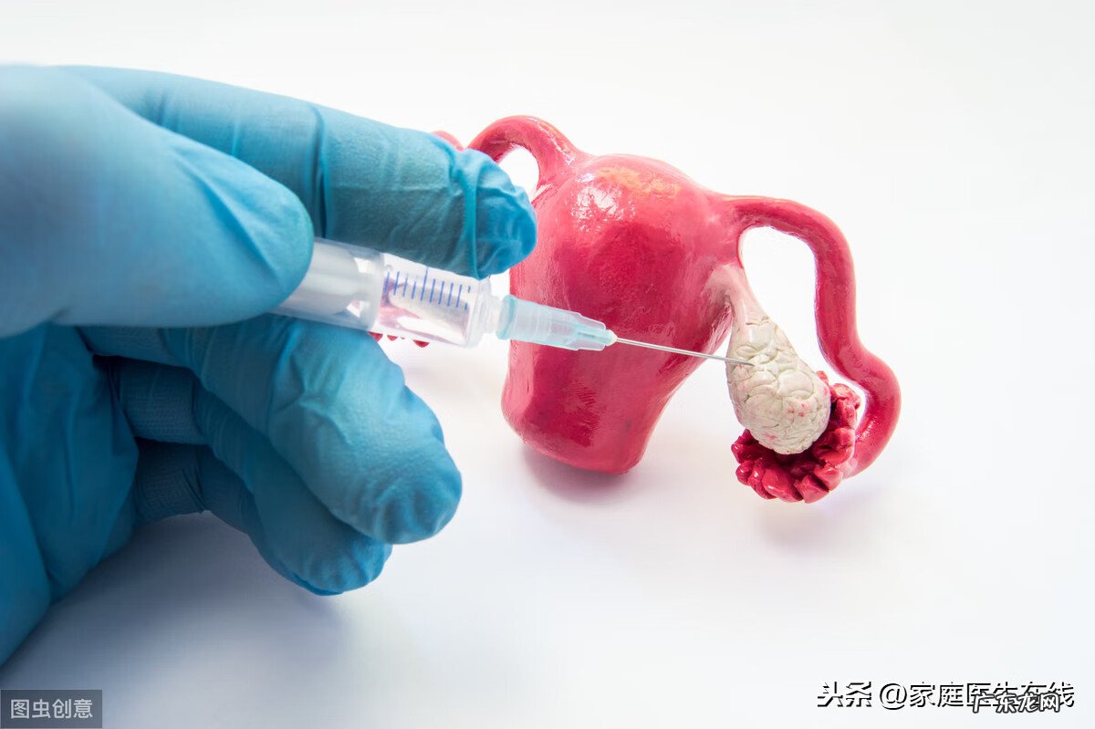 多囊卵巢综合症怎么治愈 23岁多囊卵巢综合症怎么办