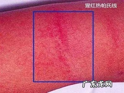 孩子为什么会莫名感染猩红热 猩红热症状有哪些