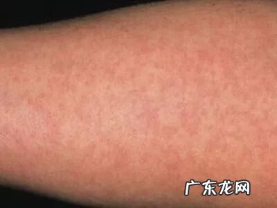 孩子为什么会莫名感染猩红热 猩红热症状有哪些