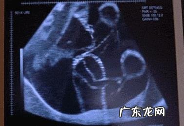 怀孕6个月宝宝胎动的厉害,正常吗?