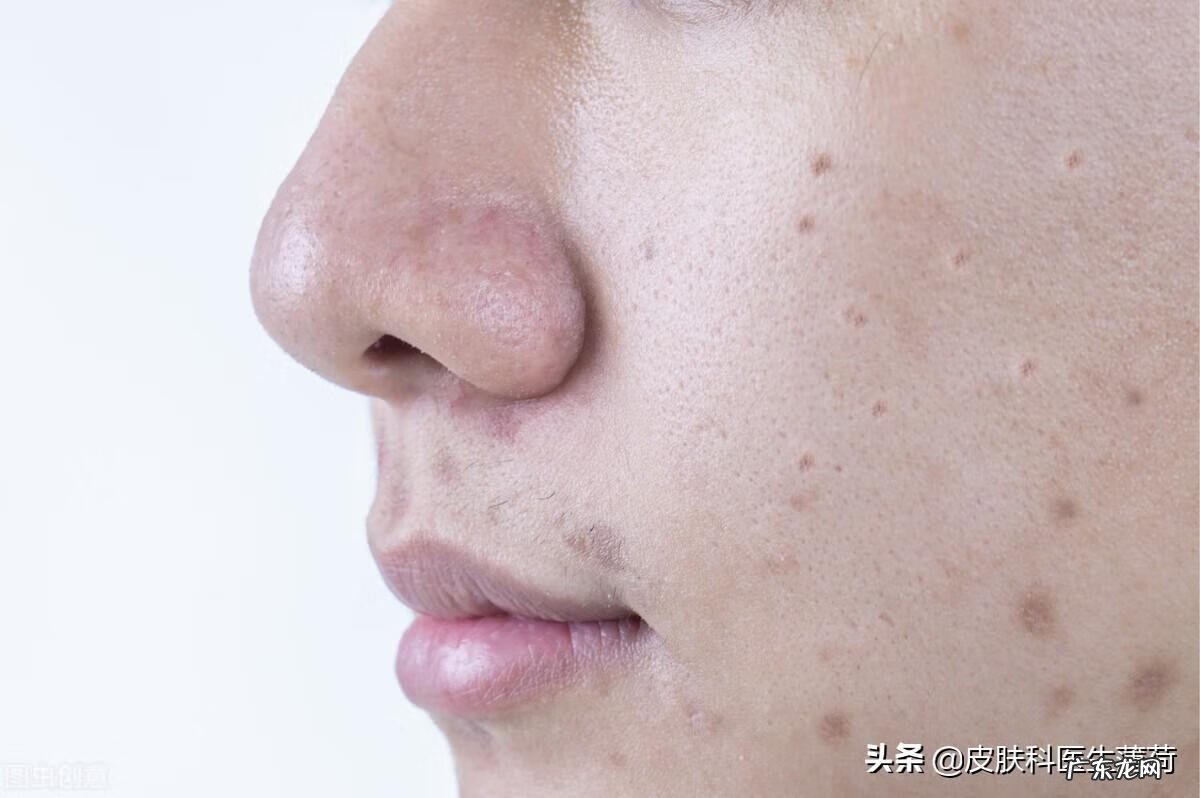 怎么样才能消痘印 怎样能消痘印