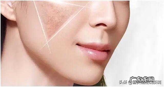 怎么祛斑 怎么祛斑更有效