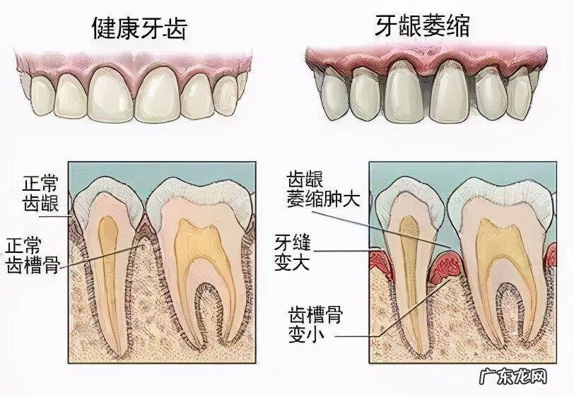 补牙可以补牙缝吗 牙齿牙缝可以补吗