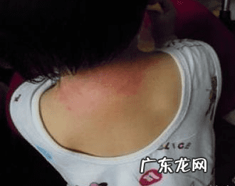 小孩身上起红疙瘩很痒是什么原因 小孩身上起红疙瘩很痒怎么办