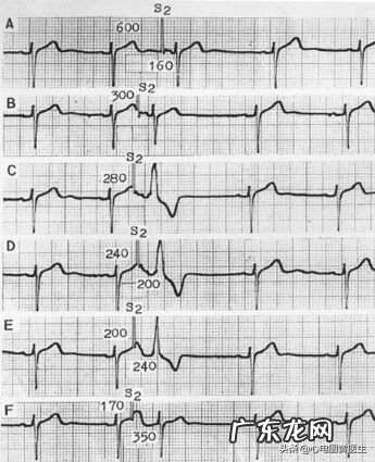 心电图详细图解 心电
